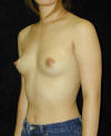 Breast Augmentation and Breast Implants Before and Afters Photos and Pictures 24a