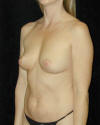 Breast Augmentation and Breast Implants Before and Afters Photos and Pictures