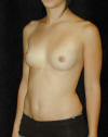 Breast Augmentation and Breast Implants Before and Afters Photos and Pictures 52a