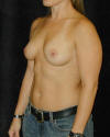 Breast Augmentation and Breast Implants Before and After Photos and Pictures 64a