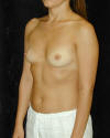 Breast Augmentation and Breast Implants Before and Afters Photos and Pictures 94a